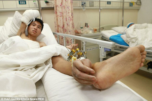 Severed hand attached-1